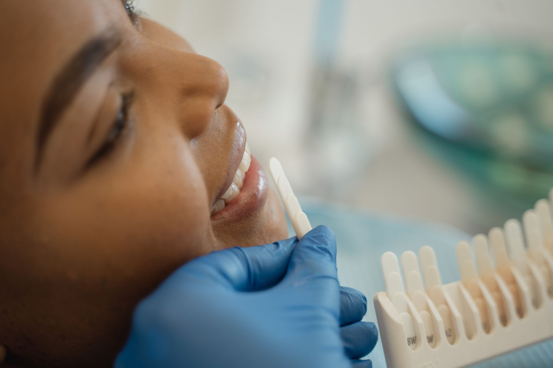 Dental Bonding Cost for Front Teeth