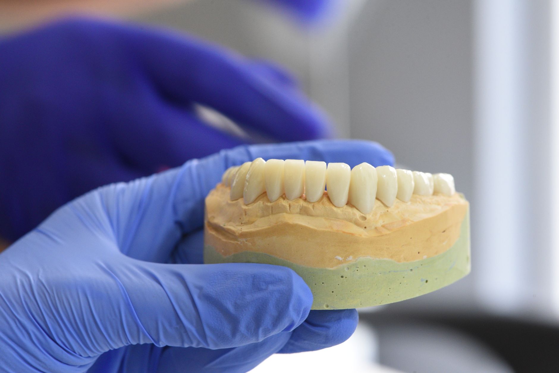 How Much Do 3D Printed Teeth Cost in India? A Comprehensive Guide